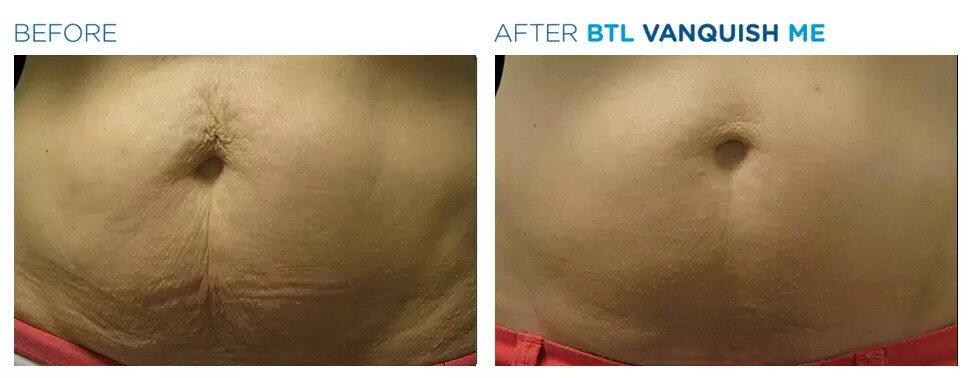 Vanquish Fat Reduction Before & After Image