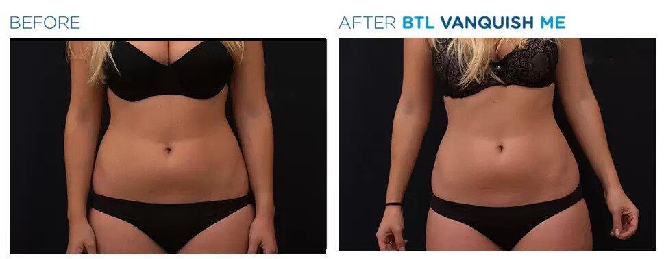 Non-Surgical Fat Removal Review - Vanquish Liposuction Results