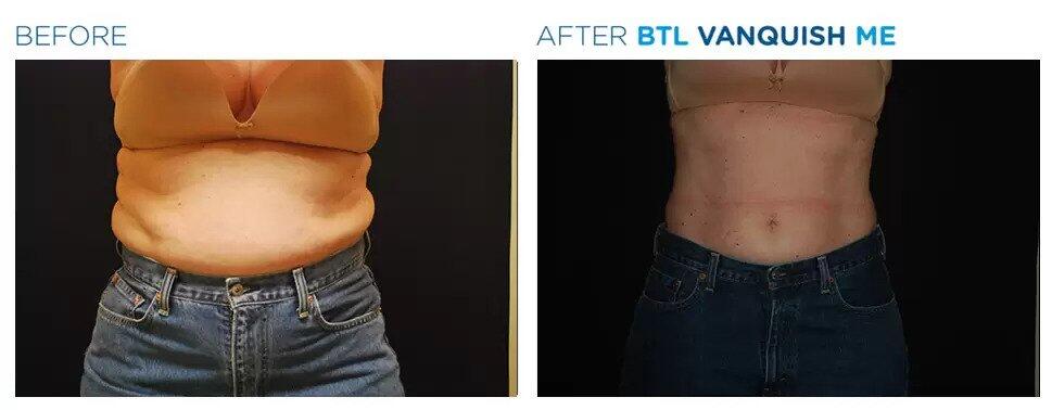 Vanquish Fat Reduction Before & After Image